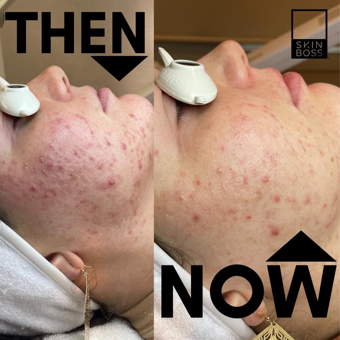Before and after shows the clients diminished acne and redness,