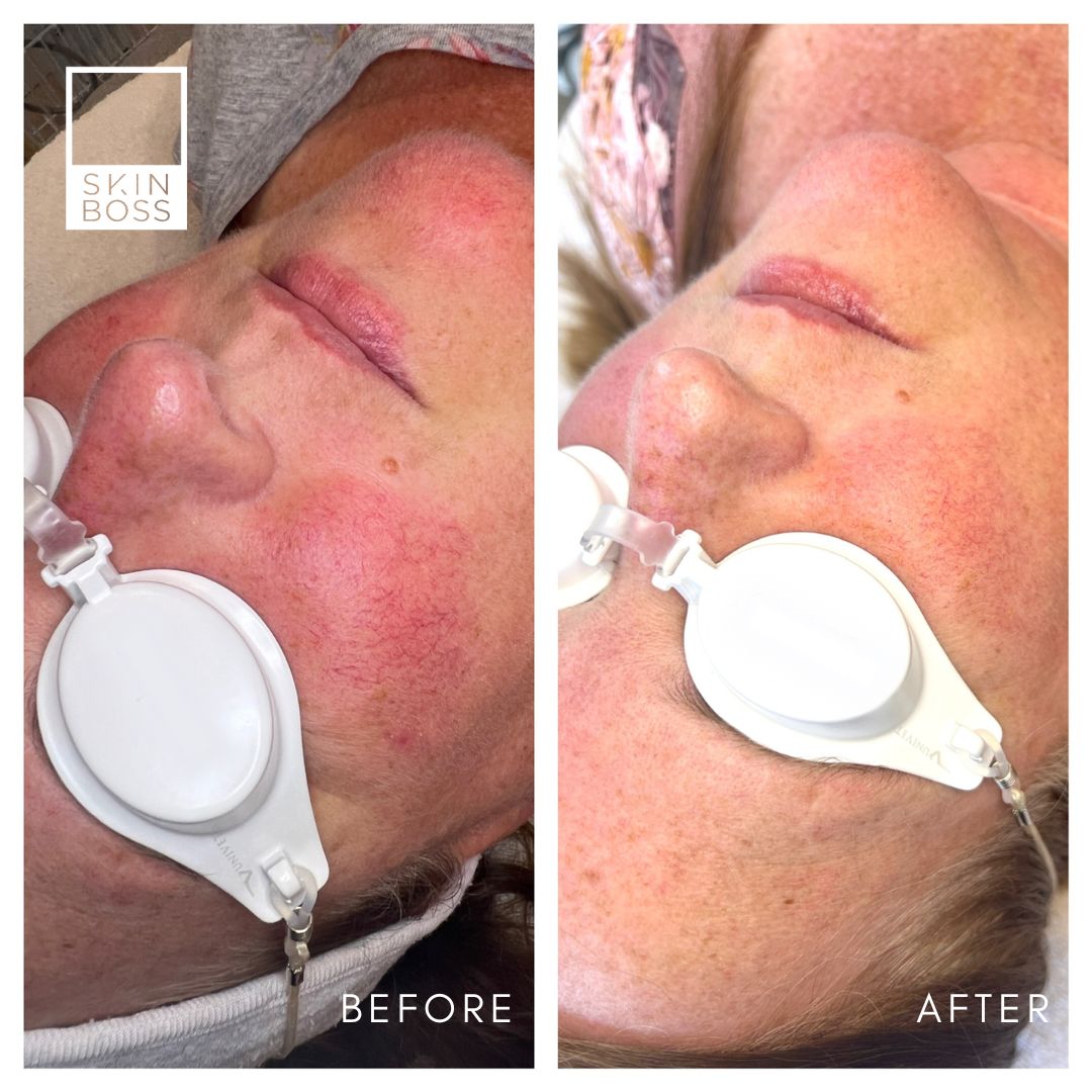 Before and after shows noticeable difference with diminished redness on their cheeks and chin.