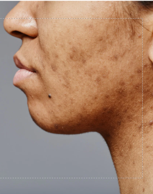 Hyperpigmentation: Chemical Peels vs. IPL |  Which Treatment Is Right for Your Skin?